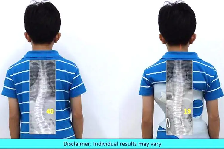 scoliosis-04