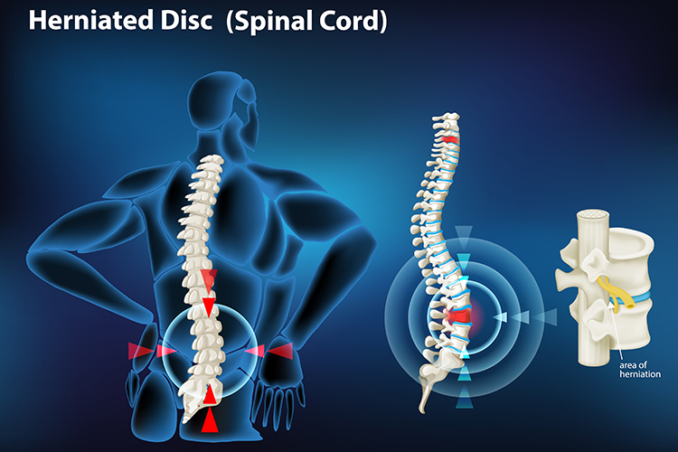 Herniated Disc, Oakleigh, VIC Chiropractor
