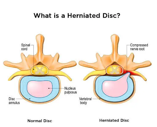 What is a Herniated Disc