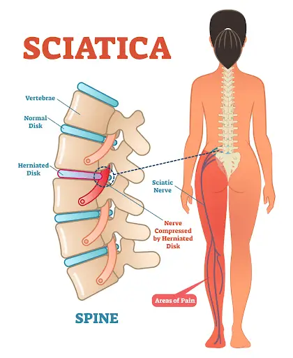 Why do some people have sciatica Why do some people have sciatica