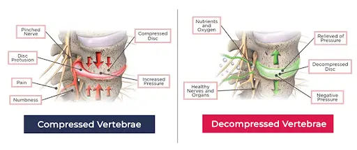 What causes a slipped disc What causes a slipped disc