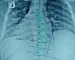 Guide to Chiropractic for Scoliosis Treatment in Singapore