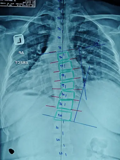 Scoliosis Traction Chair  ALL WELL Scoliosis Centre - Singapore  Chiropractic Clinic