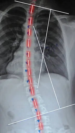 Rotating Spine