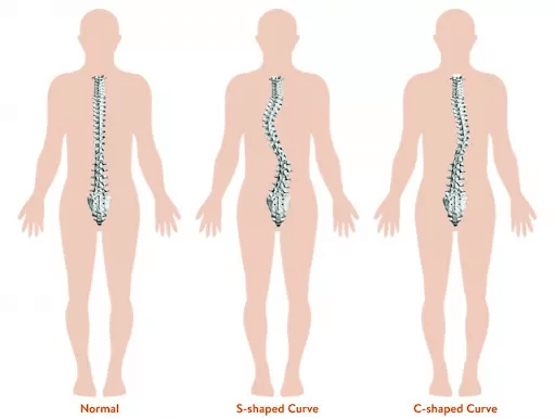 Understanding Scoliosis and Its Impact