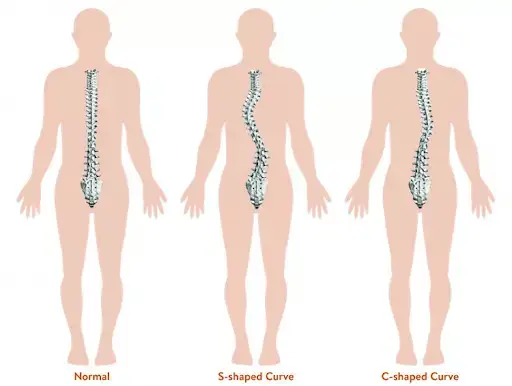 Understanding Scoliosis and Its Impact