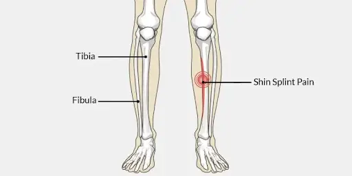 Shin Splints