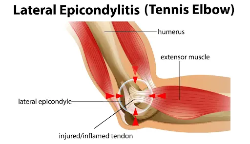 Tennis Elbow