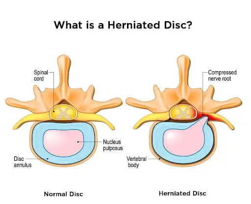 The Anatomy of a Slipped Disc - What Happens Inside