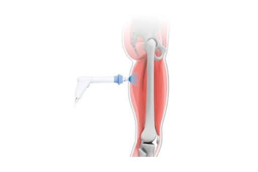 The Science Behind Shockwave Therapy in Chiropractic Care